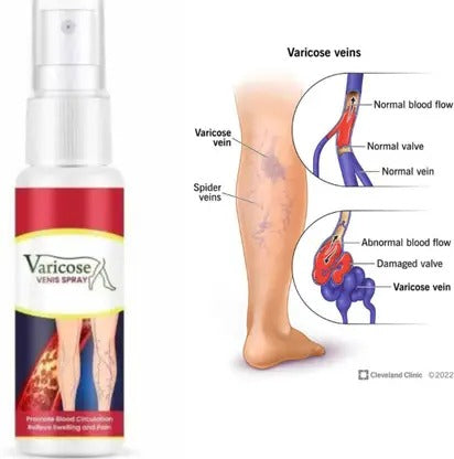 Vein Healing Varicose Veins Treatment Spray 50ml (Pack Of 2)